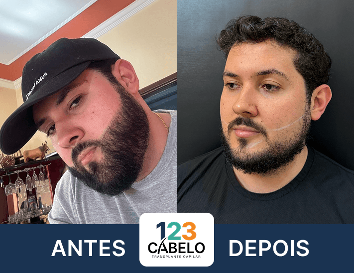case-de-sucesso-123-cabelos-transplante-capilar-em-sp-01.png