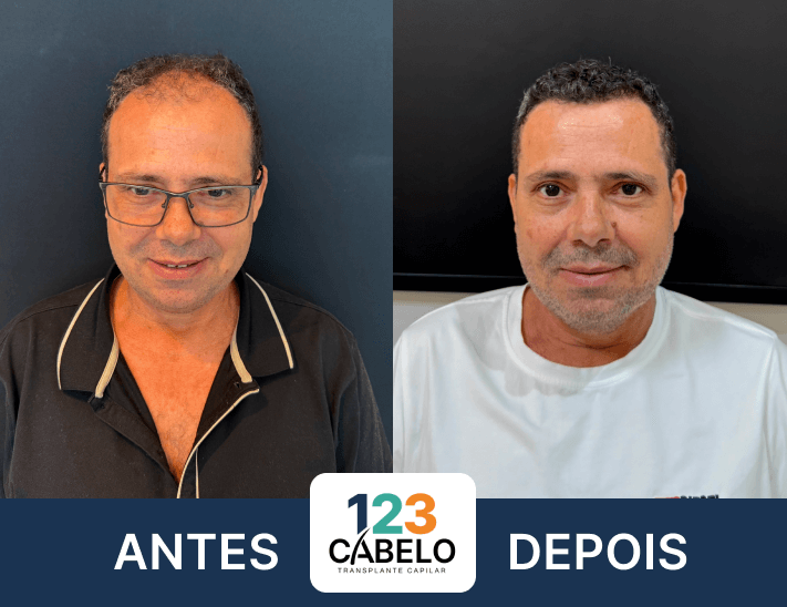 case-de-sucesso-123-cabelos-transplante-capilar-em-sp-02.png
