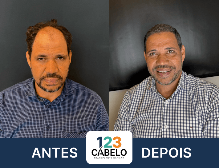 case-de-sucesso-123-cabelos-transplante-capilar-em-sp-03.png