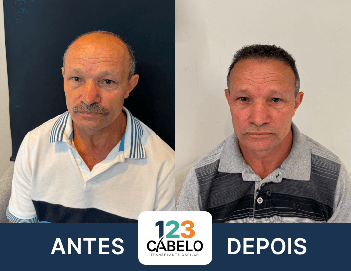 case-de-sucesso-123-cabelos-transplante-capilar-em-sp-04.png