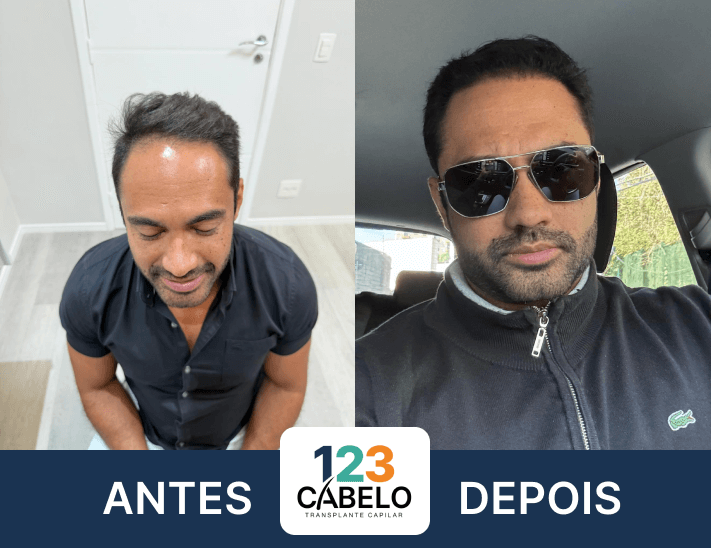 case-de-sucesso-123-cabelos-transplante-capilar-em-sp-05.png